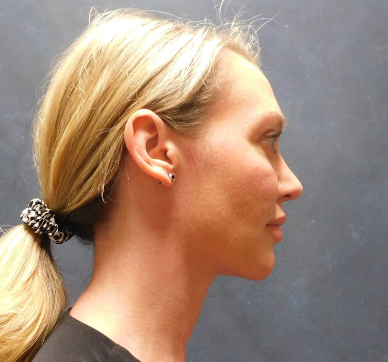 Liposuction Before & After Gallery - Patient 345373 - Image 6
