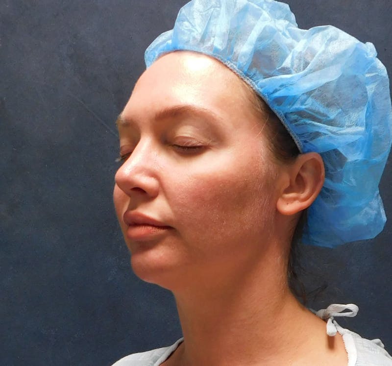 Liposuction Before & After Gallery - Patient 345373 - Image 7
