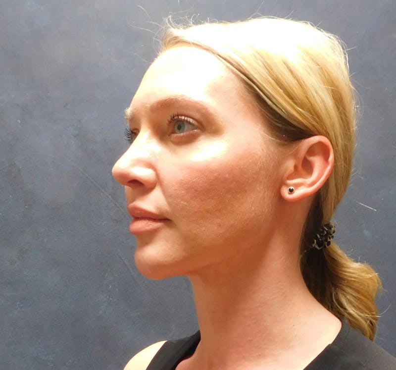 Liposuction Before & After Gallery - Patient 345373 - Image 8
