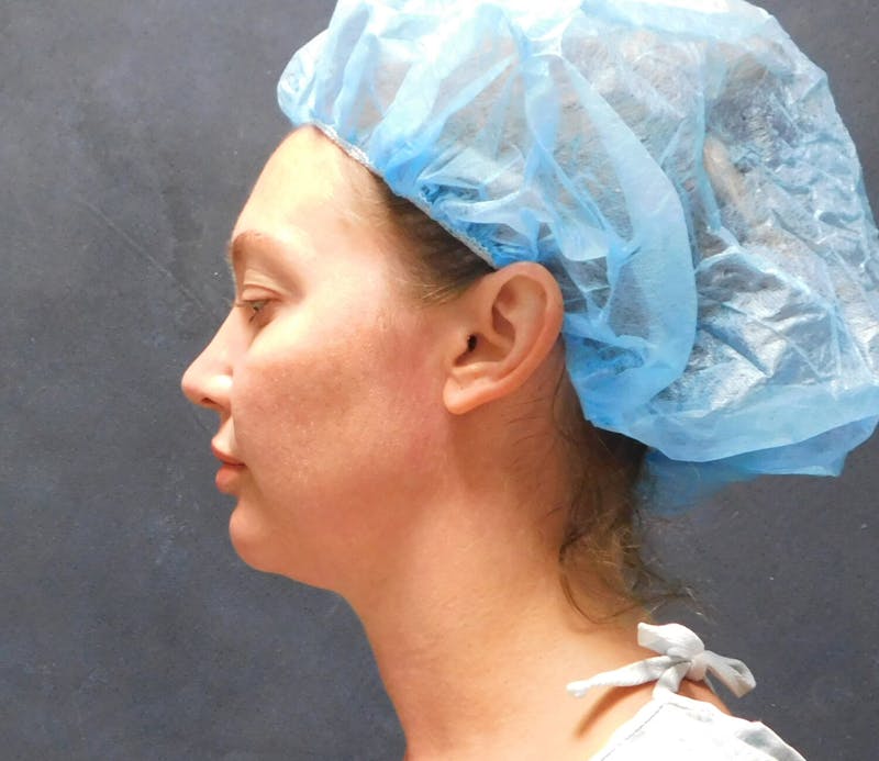 Liposuction Before & After Gallery - Patient 345373 - Image 9