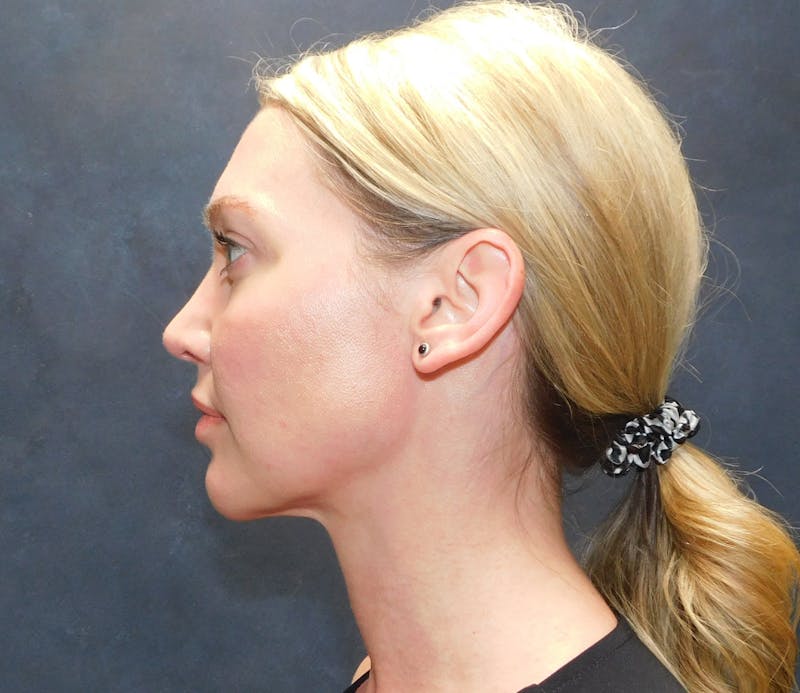 Liposuction Before & After Gallery - Patient 345373 - Image 10