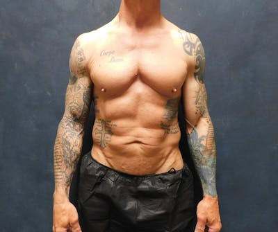 Liposuction Before & After Gallery - Patient 391990 - Image 1