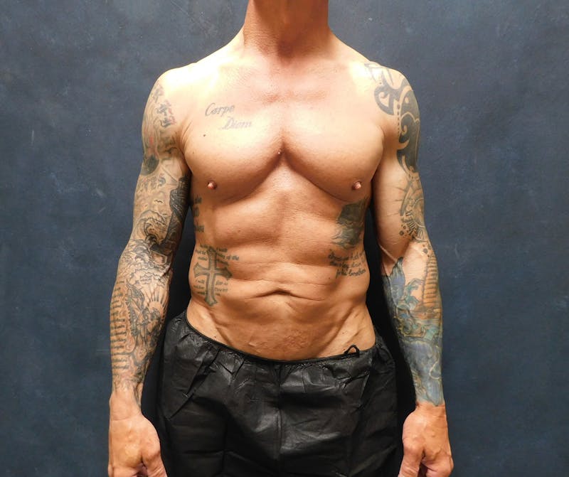 Liposuction Before & After Gallery - Patient 391990 - Image 1