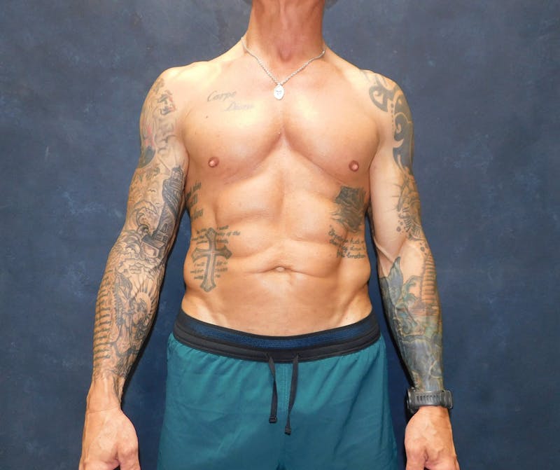 Liposuction Before & After Gallery - Patient 391990 - Image 2