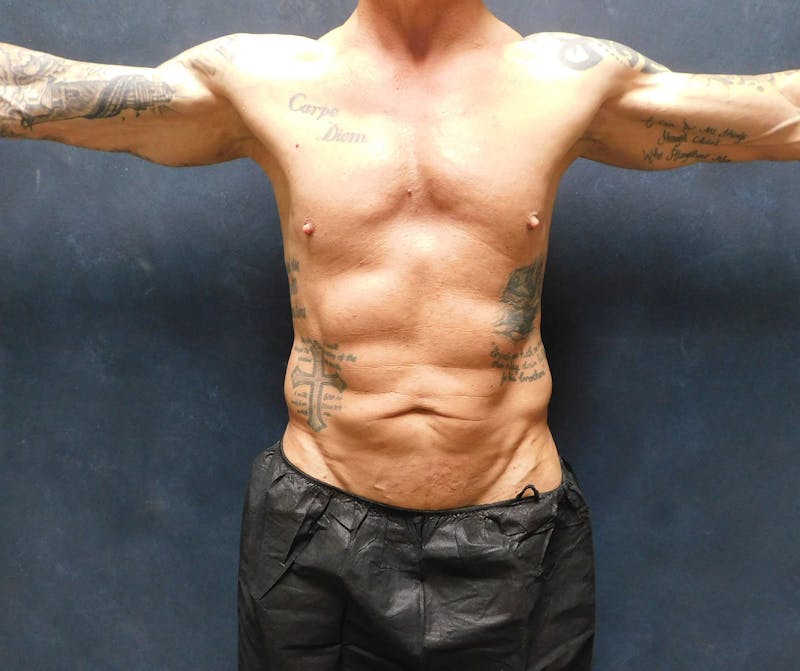 Liposuction Before & After Gallery - Patient 391990 - Image 3