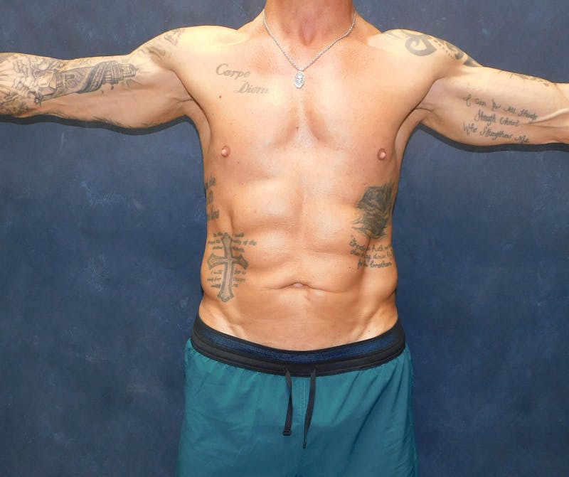 Liposuction Before & After Gallery - Patient 391990 - Image 4