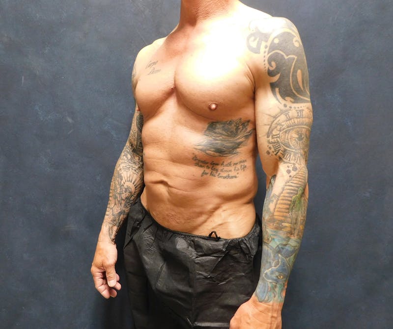 Liposuction Before & After Gallery - Patient 391990 - Image 5