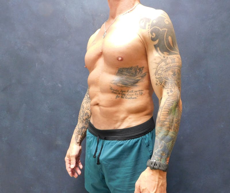 Liposuction Before & After Gallery - Patient 391990 - Image 6