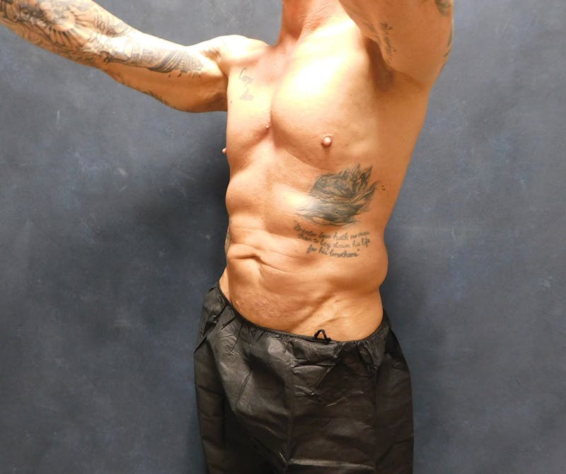 Liposuction Before & After Gallery - Patient 391990 - Image 7