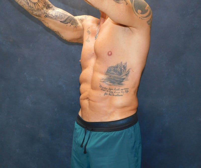 Liposuction Before & After Gallery - Patient 391990 - Image 8