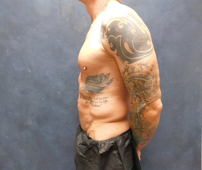 Liposuction Before & After Gallery - Patient 391990 - Image 9