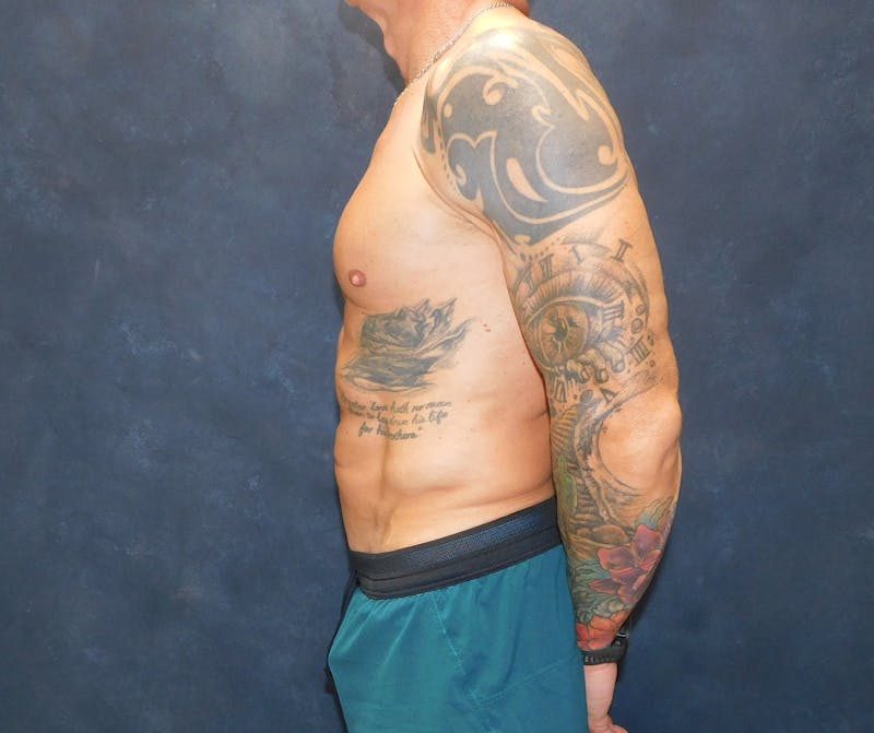 Liposuction Before & After Gallery - Patient 391990 - Image 10
