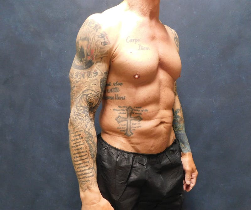 Liposuction Before & After Gallery - Patient 391990 - Image 11