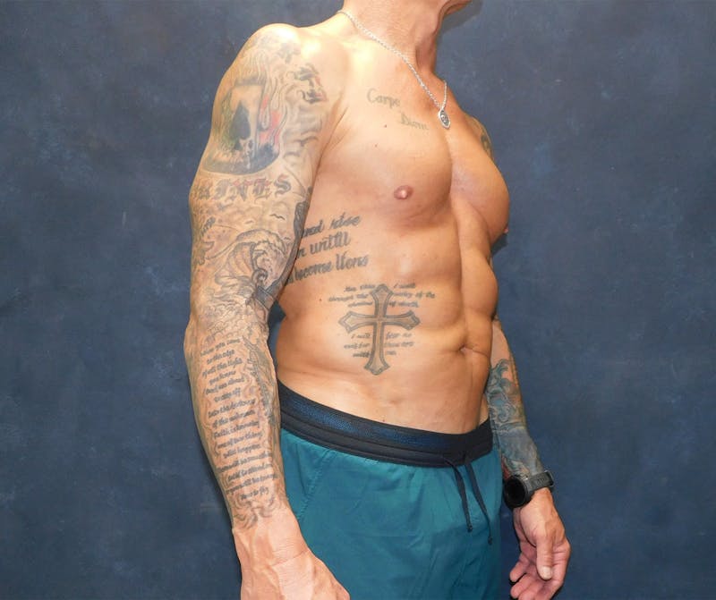 Liposuction Before & After Gallery - Patient 391990 - Image 12