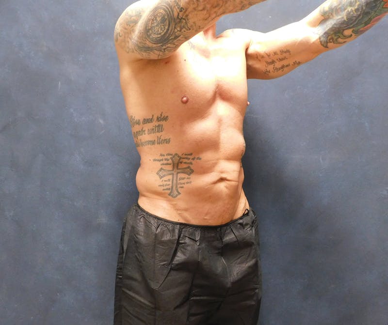 Liposuction Before & After Gallery - Patient 391990 - Image 13