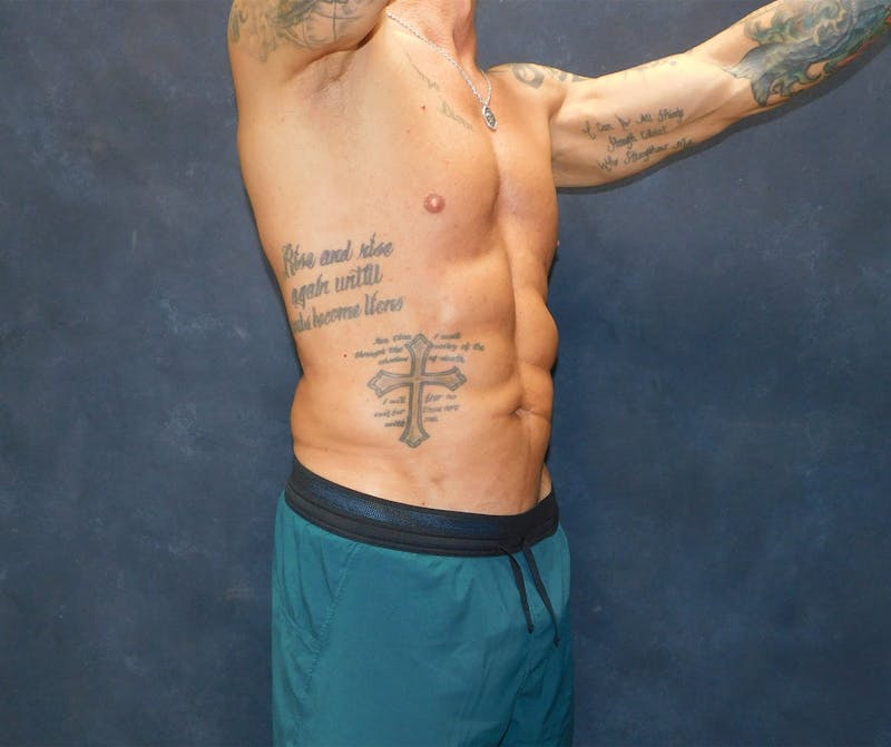 Liposuction Before & After Gallery - Patient 391990 - Image 14