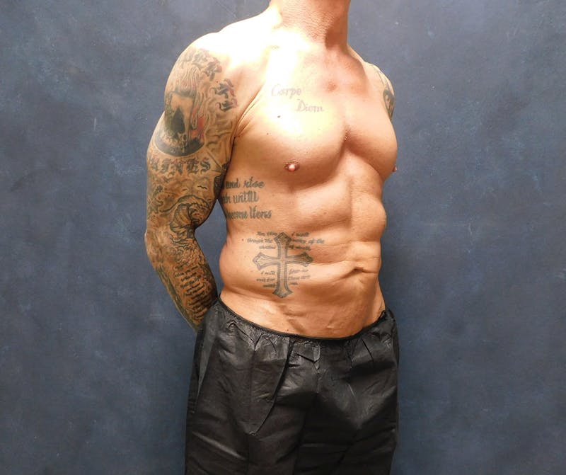 Liposuction Before & After Gallery - Patient 391990 - Image 15