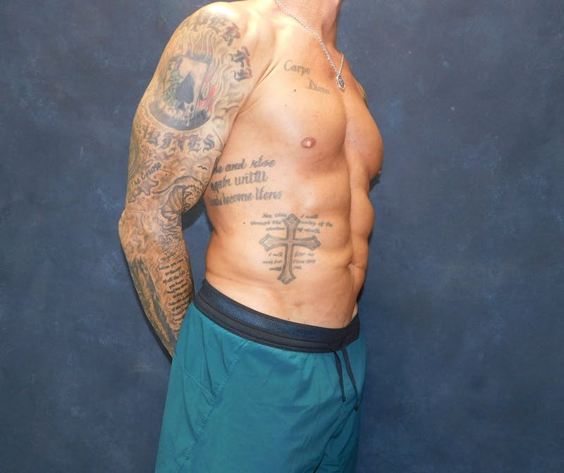 Liposuction Before & After Gallery - Patient 391990 - Image 16