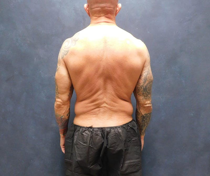 Liposuction Before & After Gallery - Patient 391990 - Image 17