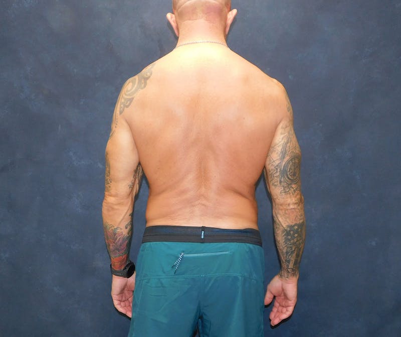 Liposuction Before & After Gallery - Patient 391990 - Image 18