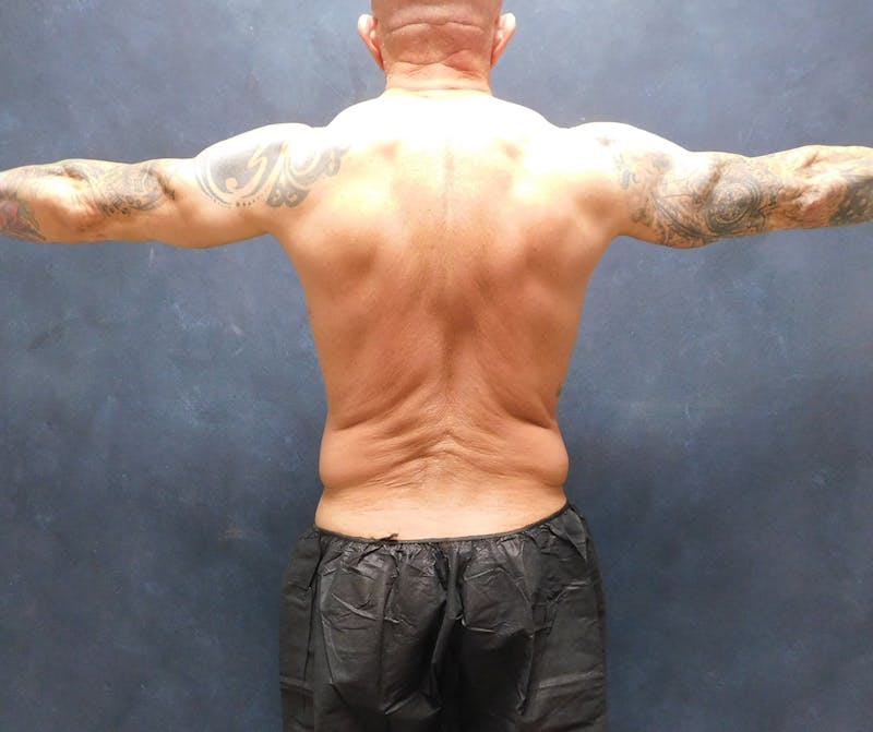 Liposuction Before & After Gallery - Patient 391990 - Image 19