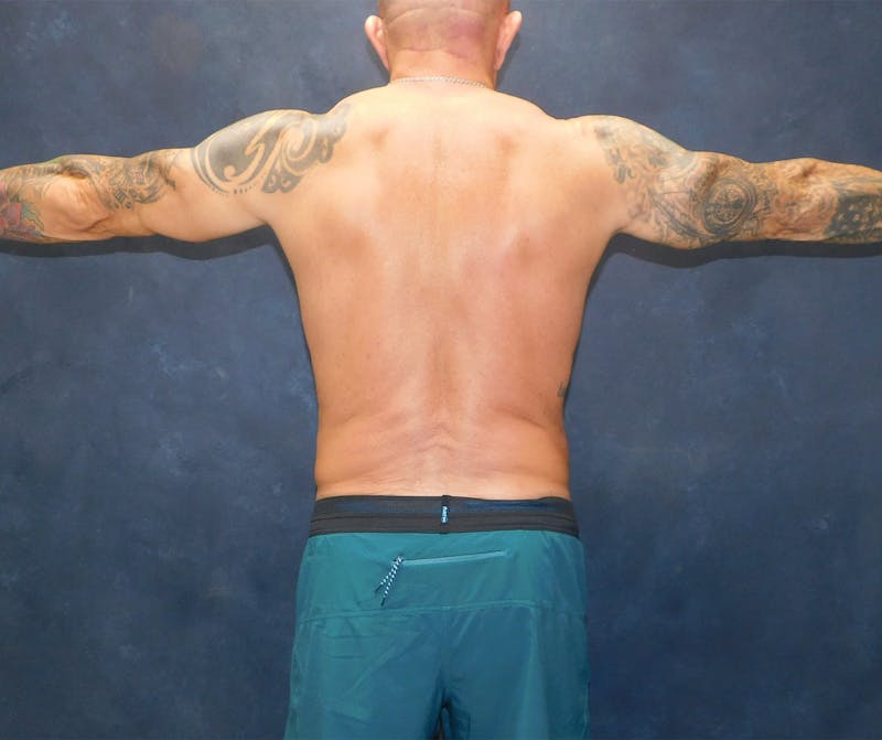 Liposuction Before & After Gallery - Patient 391990 - Image 20