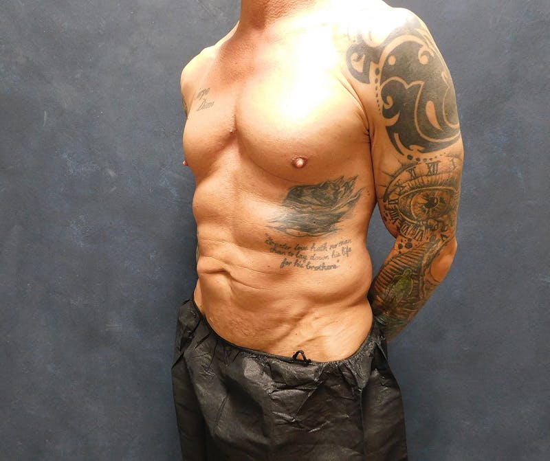 Liposuction Before & After Gallery - Patient 391990 - Image 21