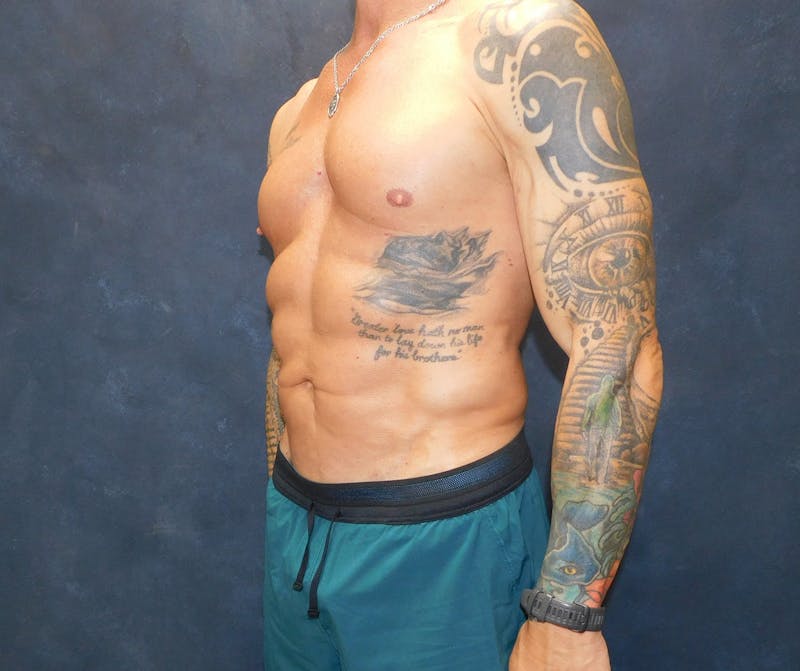 Liposuction Before & After Gallery - Patient 391990 - Image 22
