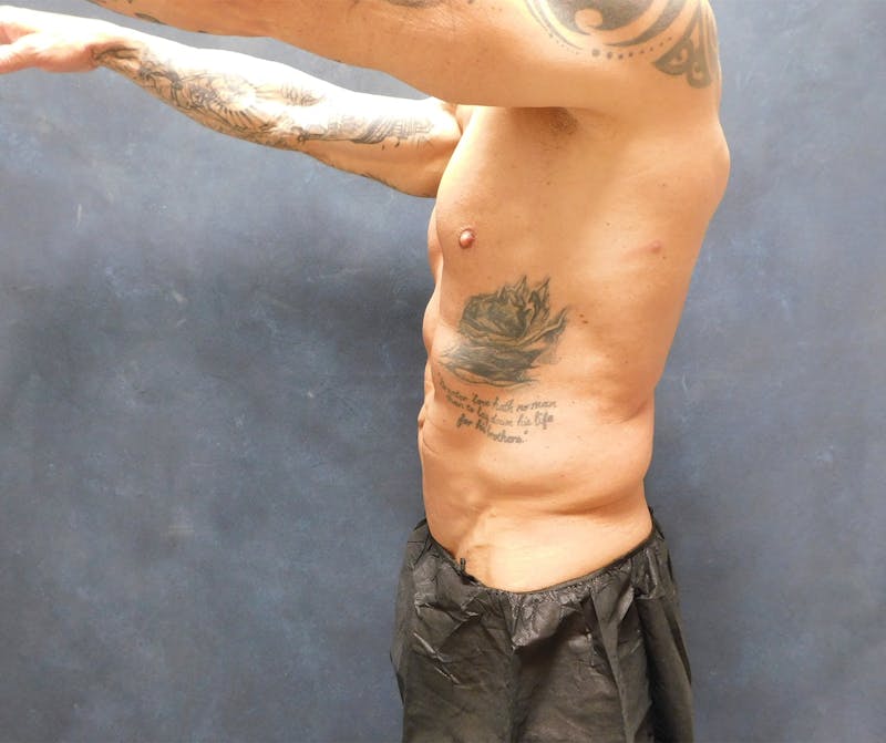 Liposuction Before & After Gallery - Patient 391990 - Image 23