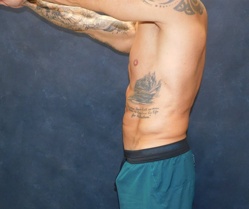 Liposuction Before & After Gallery - Patient 391990 - Image 24