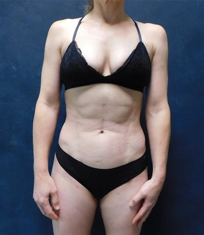 High Definition Liposuction Before & After Gallery - Patient 238260 - Image 2