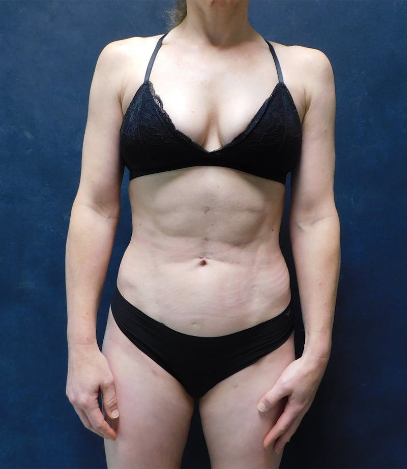 Liposuction Before & After Gallery - Patient 111973 - Image 2