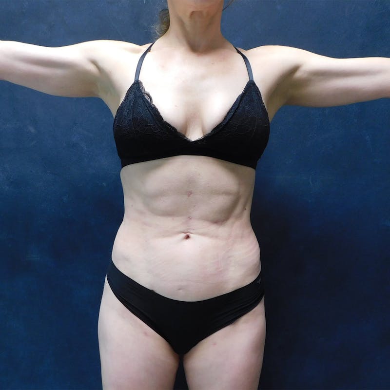 Liposuction Before & After Gallery - Patient 111973 - Image 4