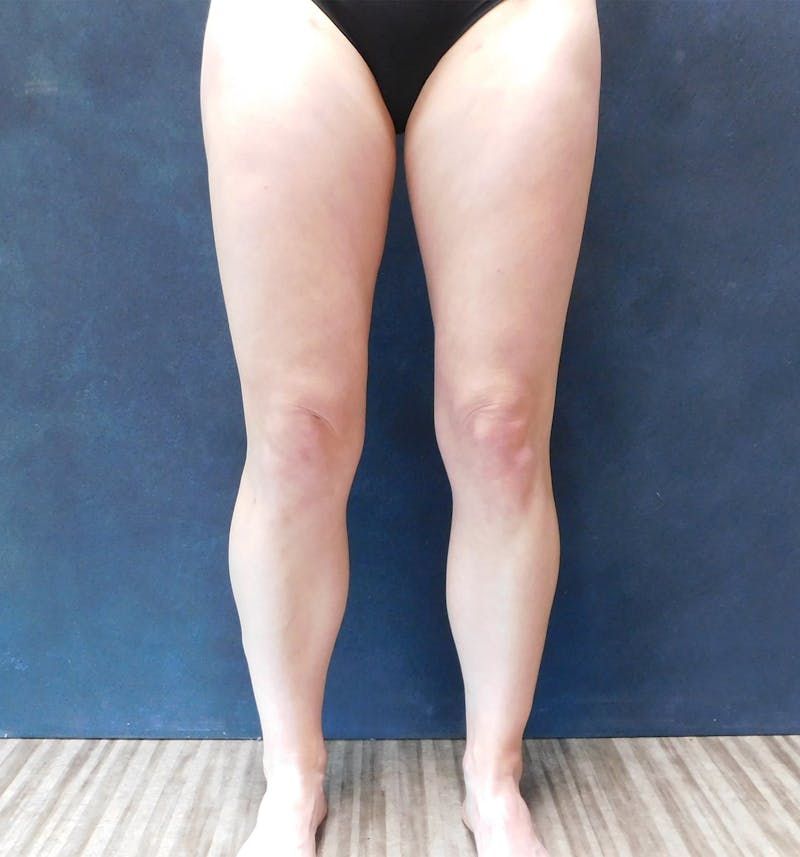 Liposuction Before & After Gallery - Patient 111973 - Image 6