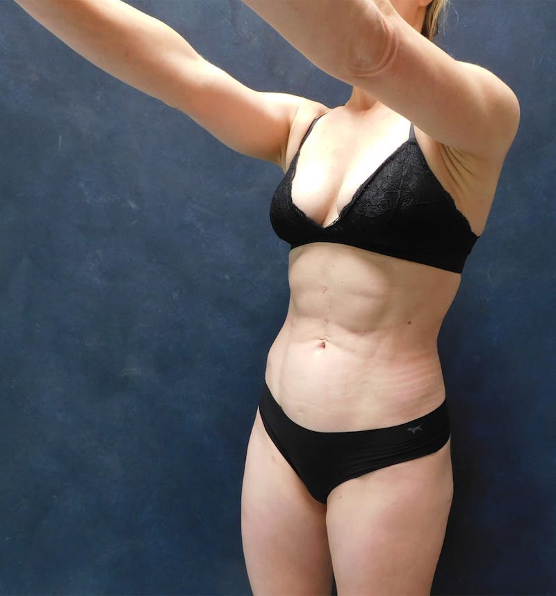 Liposuction Before & After Gallery - Patient 111973 - Image 10