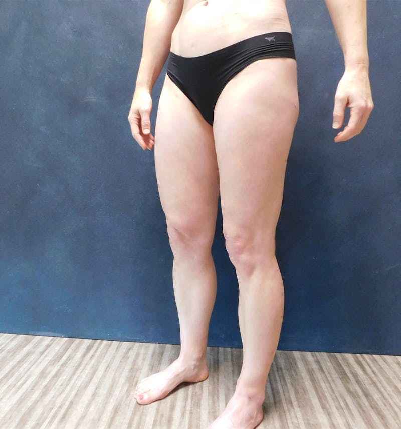 Liposuction Before & After Gallery - Patient 111973 - Image 14
