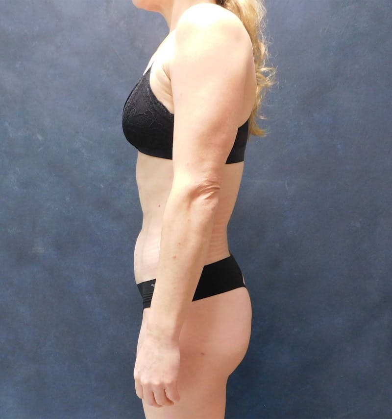 Liposuction Before & After Gallery - Patient 111973 - Image 16