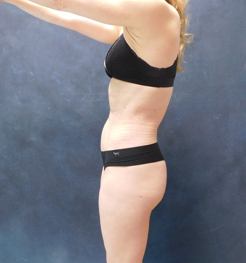 Liposuction Before & After Gallery - Patient 111973 - Image 18