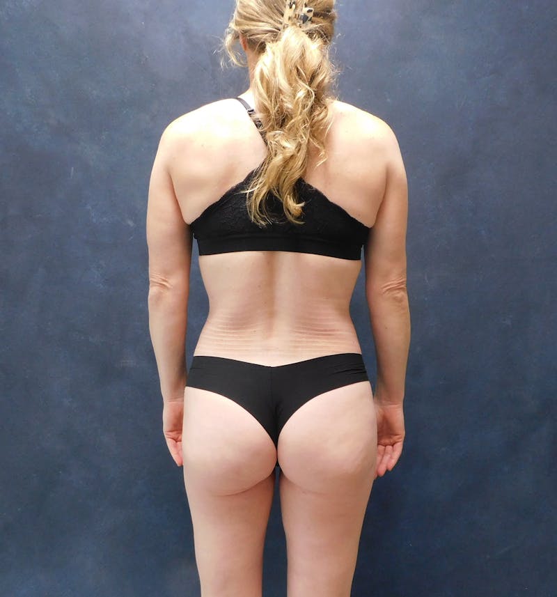 Liposuction Before & After Gallery - Patient 111973 - Image 22