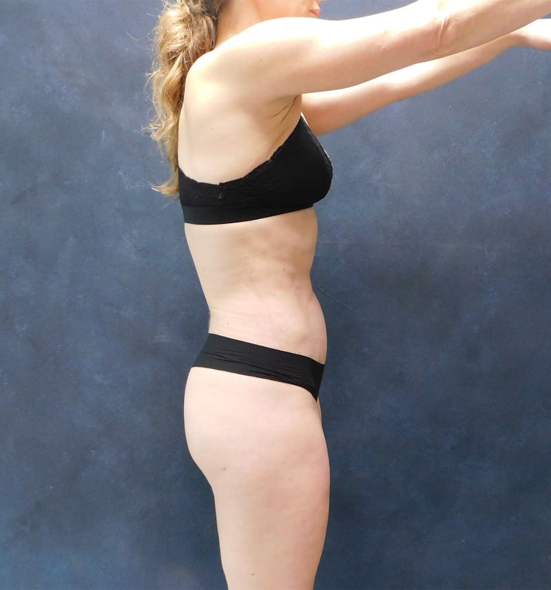 Liposuction Before & After Gallery - Patient 111973 - Image 28