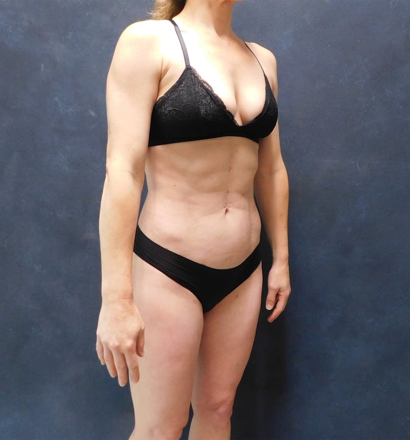 Liposuction Before & After Gallery - Patient 111973 - Image 32