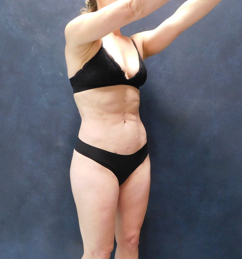 Liposuction Before & After Gallery - Patient 111973 - Image 34