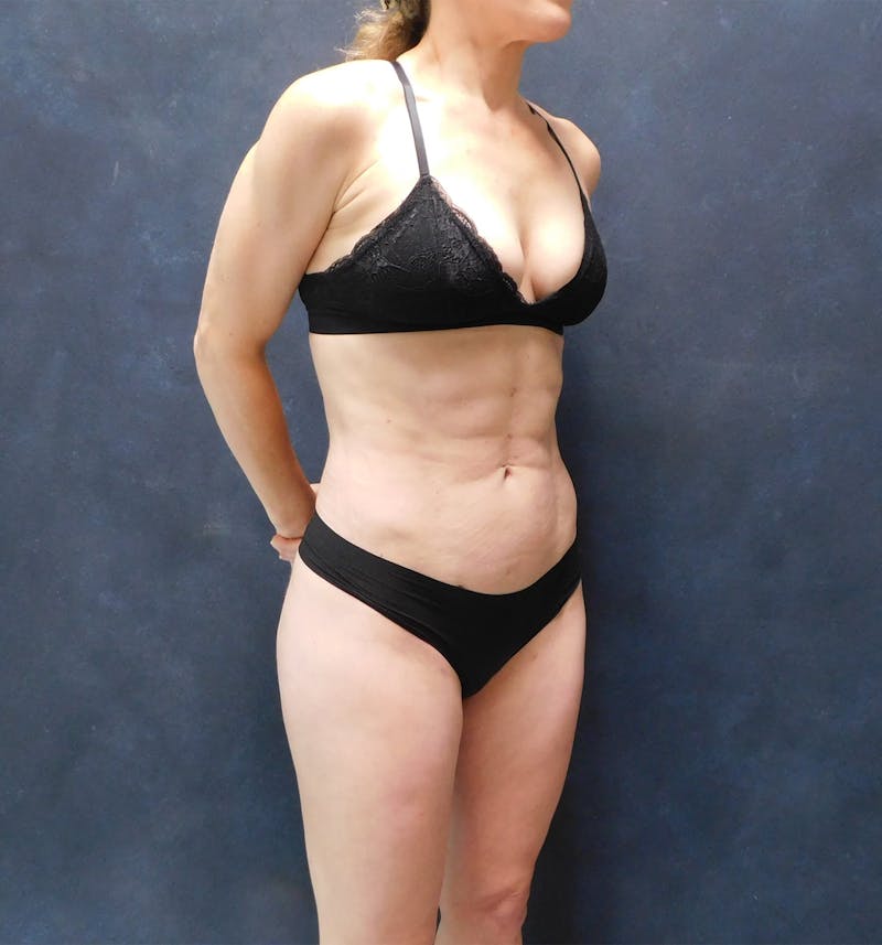 Liposuction Before & After Gallery - Patient 111973 - Image 36