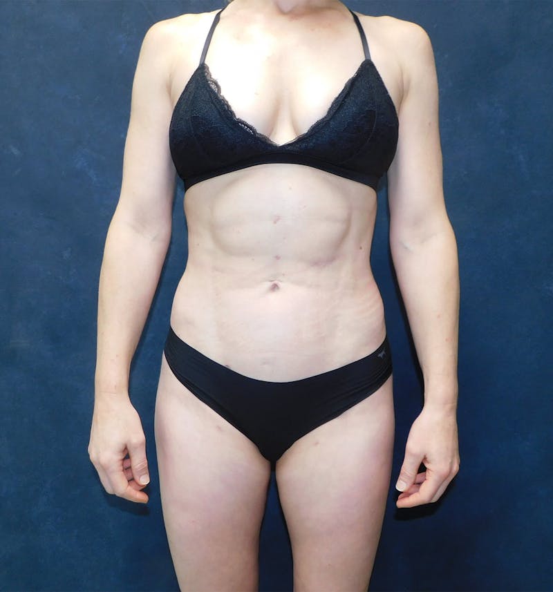 Liposuction Before & After Gallery - Patient 111973 - Image 38