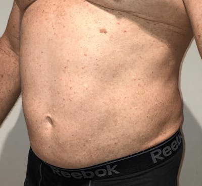 High Definition Liposuction Before & After Gallery - Patient 324074 - Image 1