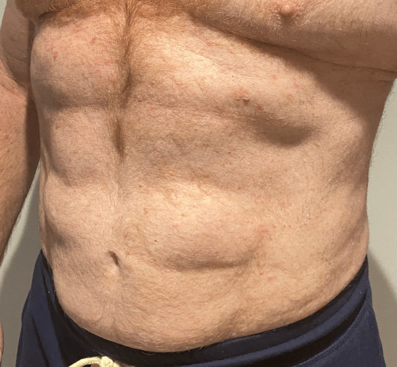 High Definition Liposuction Before & After Gallery - Patient 324074 - Image 2