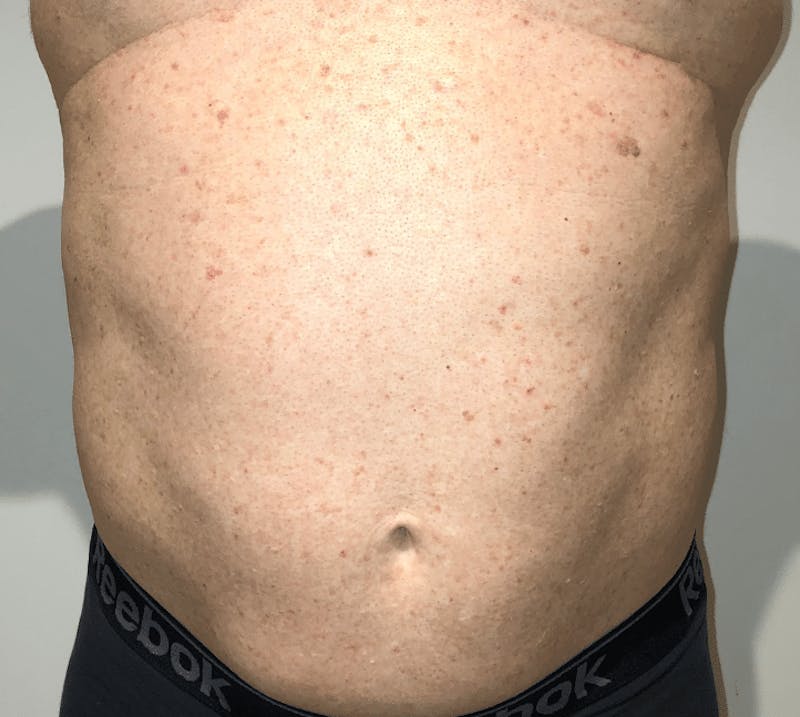 High Definition Liposuction Before & After Gallery - Patient 324074 - Image 3