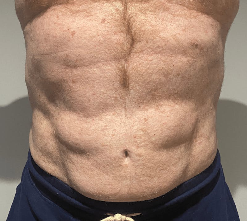 High Definition Liposuction Before & After Gallery - Patient 324074 - Image 4