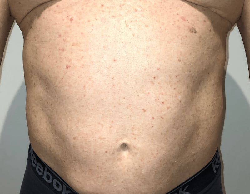 High Definition Liposuction Before & After Gallery - Patient 324074 - Image 5