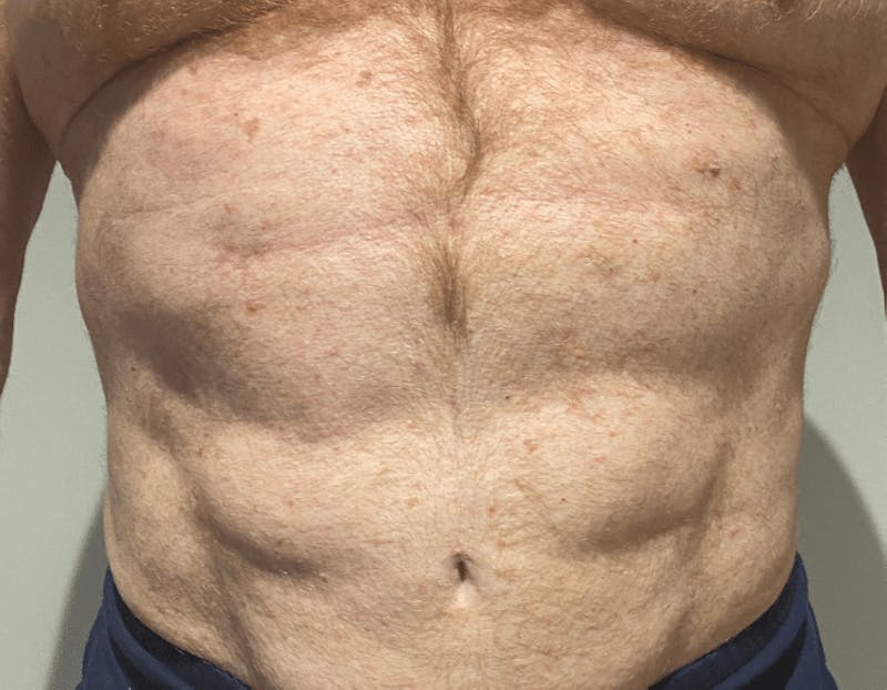 High Definition Liposuction Before & After Gallery - Patient 324074 - Image 6